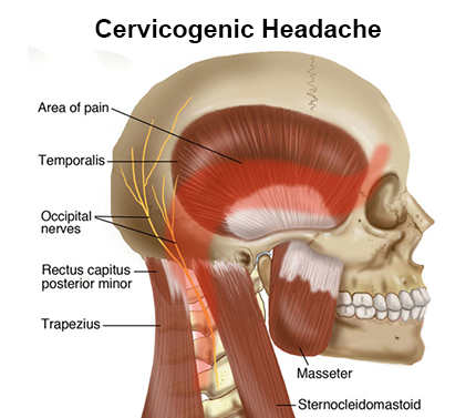 Cervicogenic Headache Image