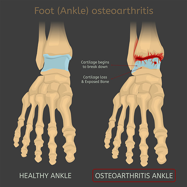 Graphic of arthritis of the ankle