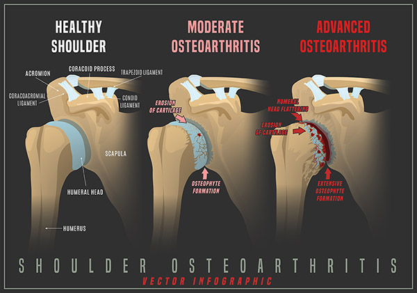 Graphic of arthritis shoulder