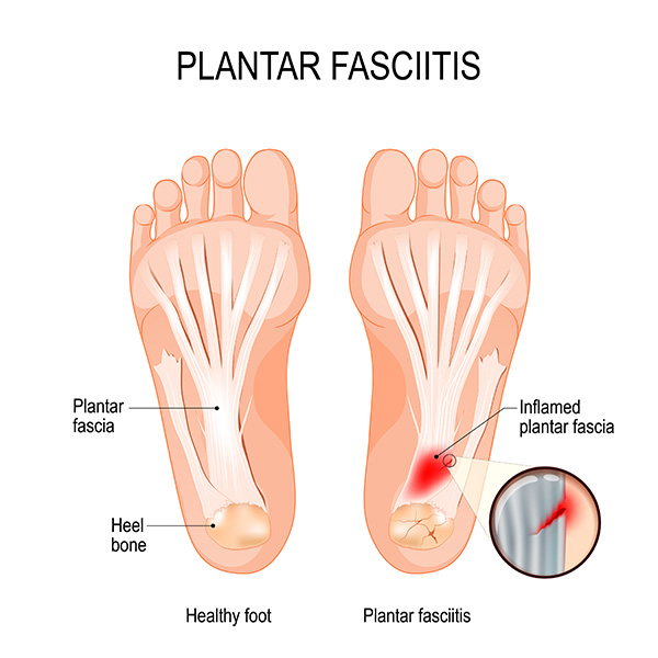 Graphic of Plantar fasciitis