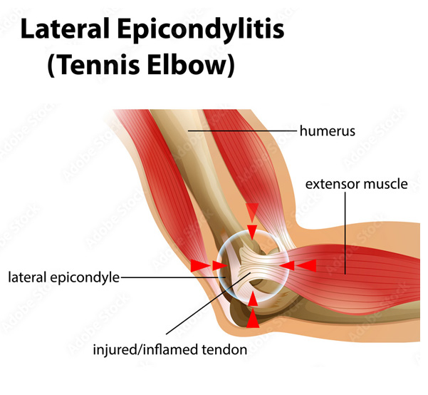 Graphic of tennis eblow tendinitus
